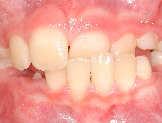 Застосування гелю для відбілювання зубів