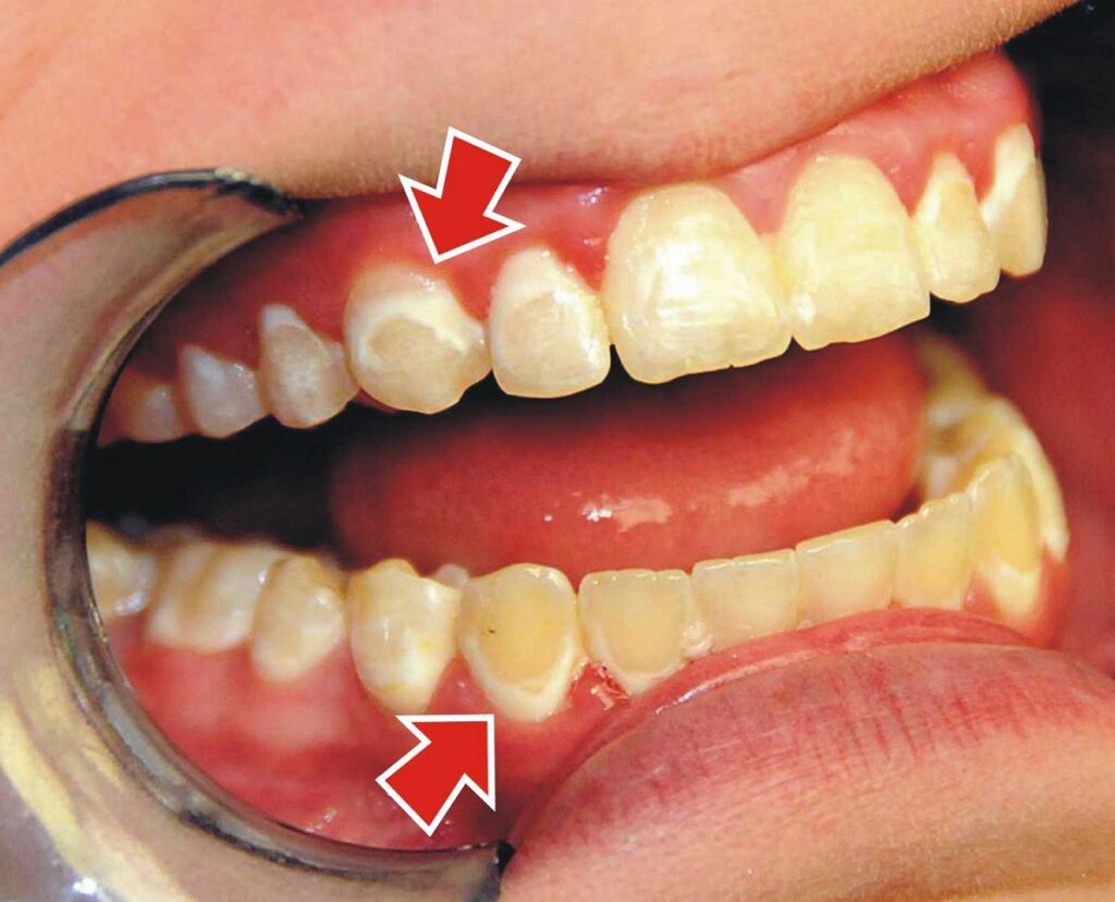зубний наліт
