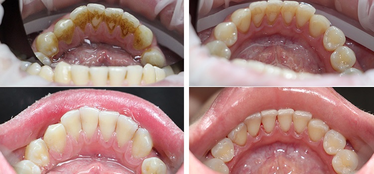 ультразвуковая чистка зубов до и после
